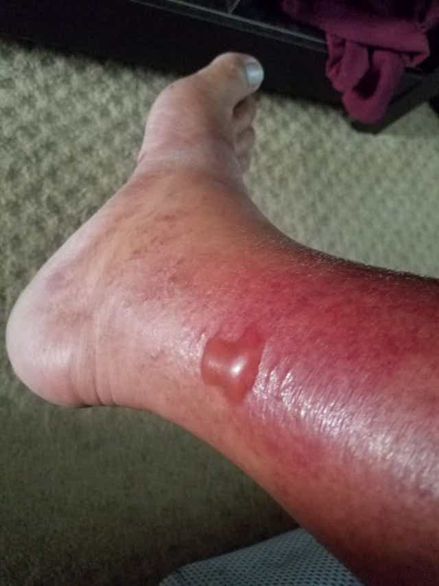 Flesh Eating Bacteria Florida Man Nearly Dies After Fishing Trip