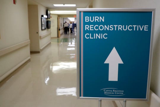 Outpatient burn clinic open at Capital Regional Medical Center