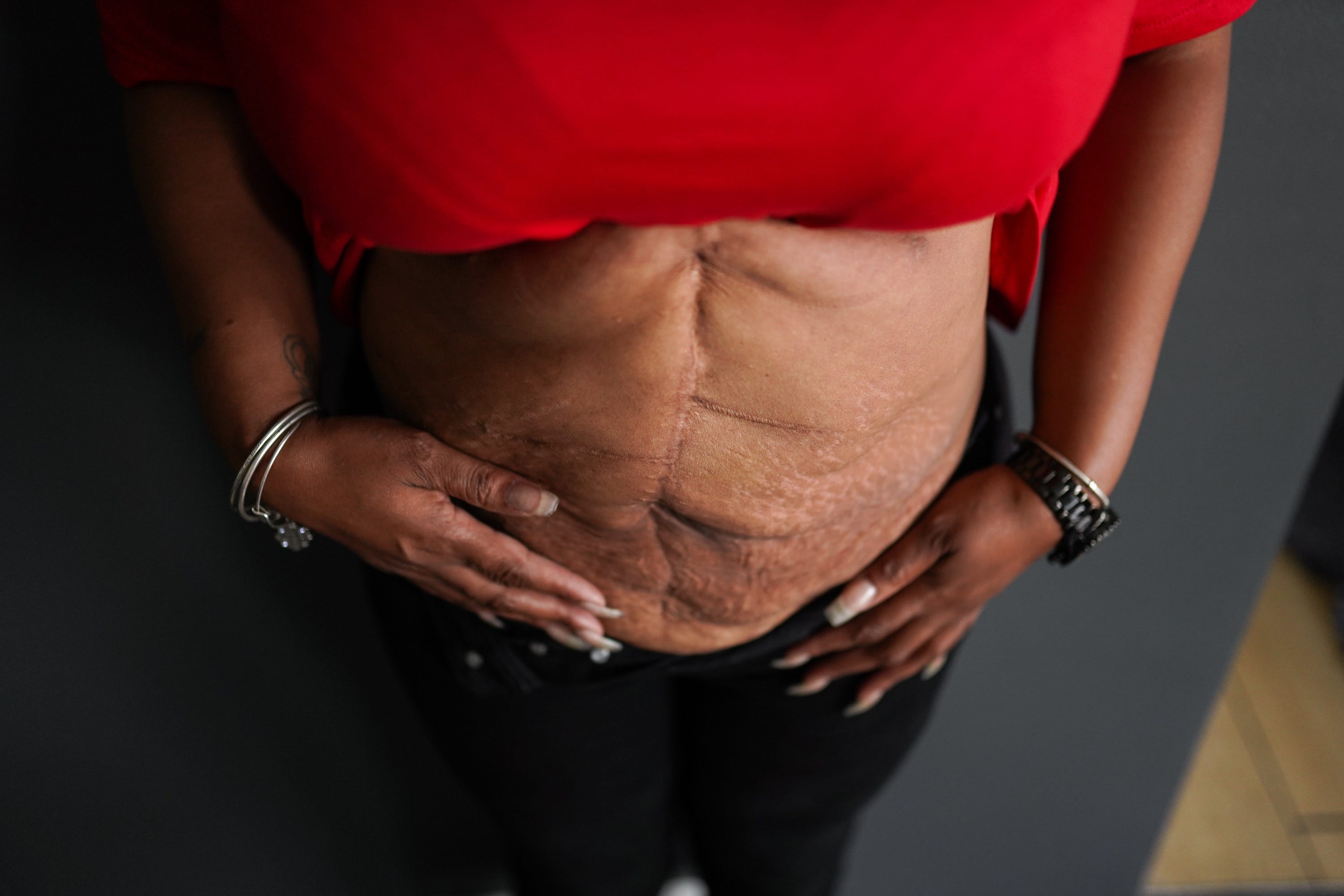 Detroit resident Nyosha Fowler was seriously injured in 2015 when Dr. Osakatukei Omulepu accidentally punctured her bowels during liposuction and injected fat into her sciatic nerve during a Brazilian butt lift in Florida. Fowler’s stomach remains scarred.