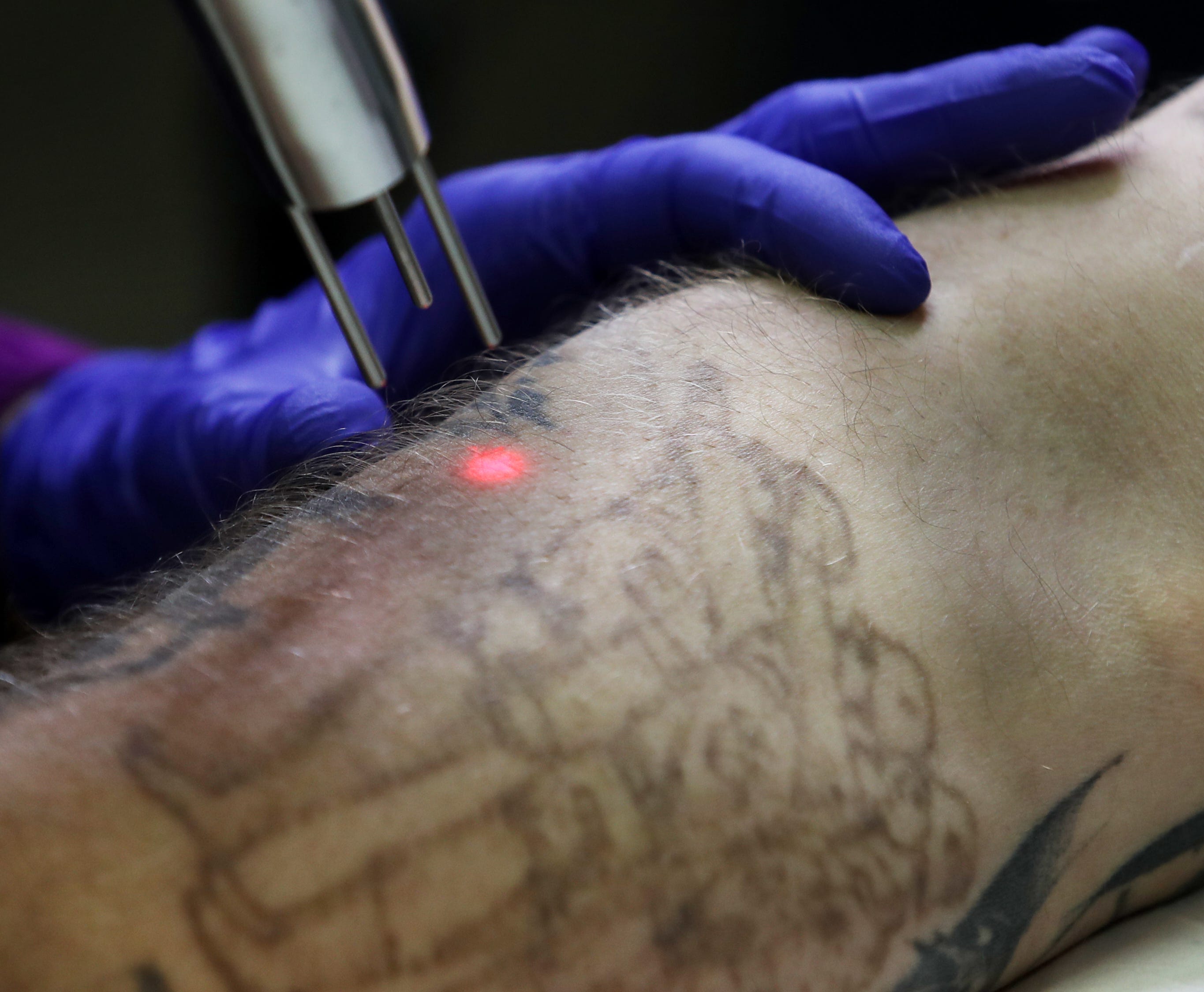 Tattoo Removal Ink Helps Former Kentucky Felons Find Work New Life