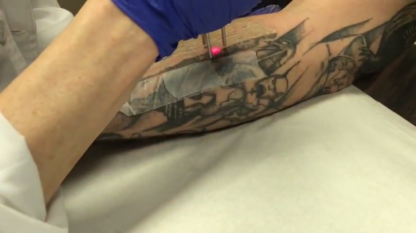 Tattoo Removal Louisville KY  Brows Fanatics Studio  More