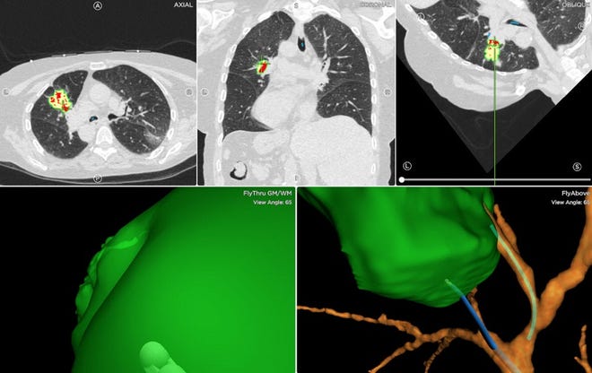 Navigational bronchoscopy pinpoints areas for physicians to biopsy.