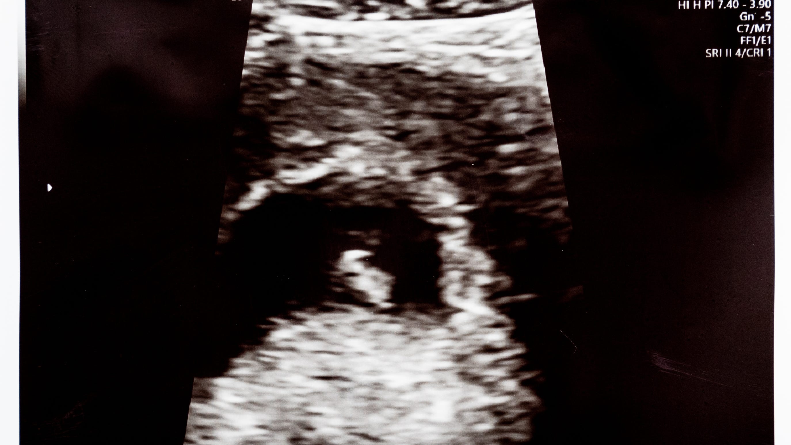 An image of a six week, 3 day old embryo is seen on an ultrasound on Wednesday, May 30, 2018, in Des Moines.