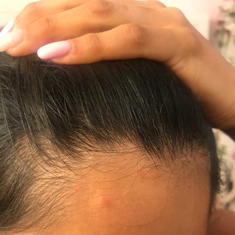 Here's a look at the bed bug bites.
