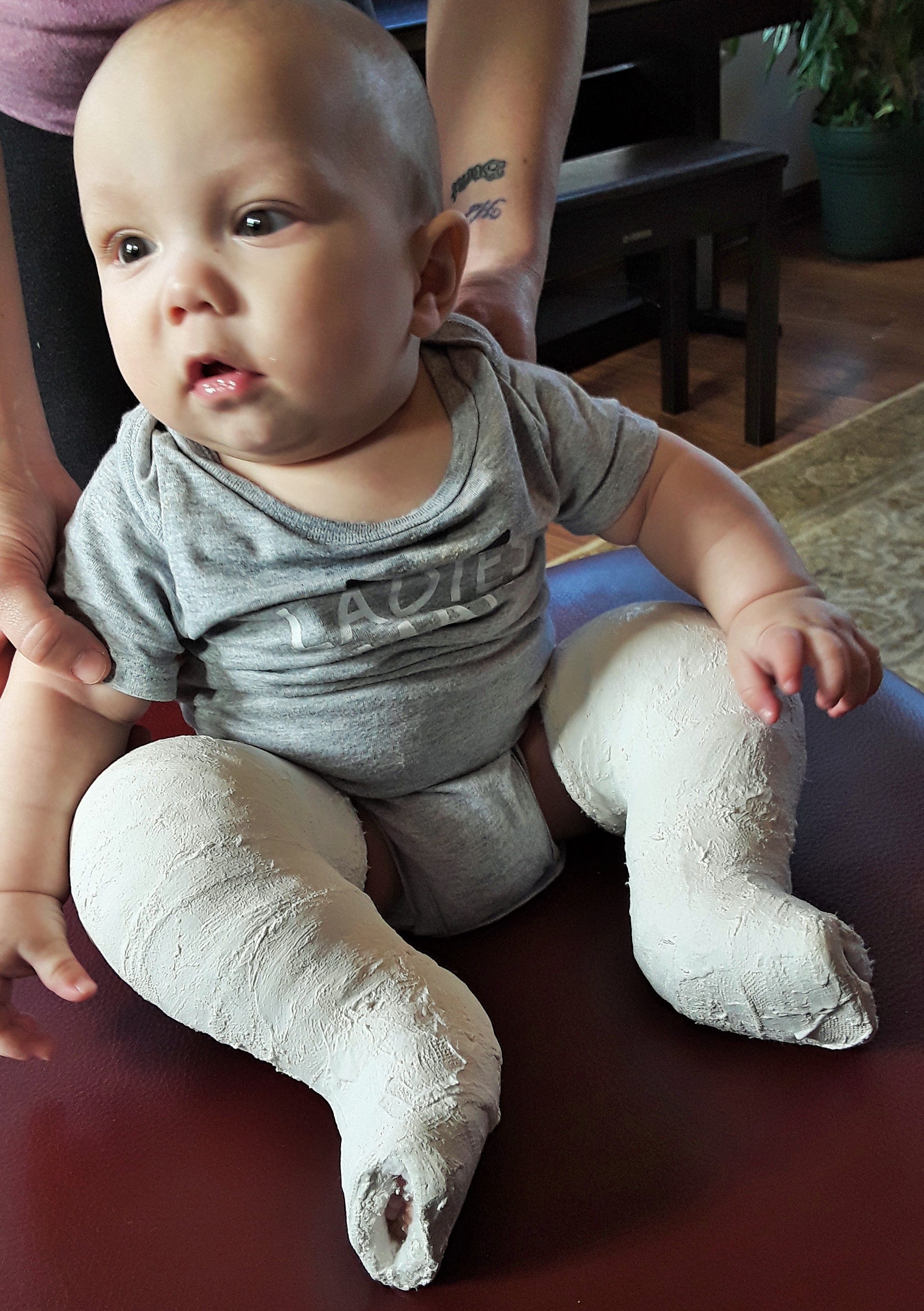 Clubfoot Treatment At Uihc Providing New Hope For Canadian Boy