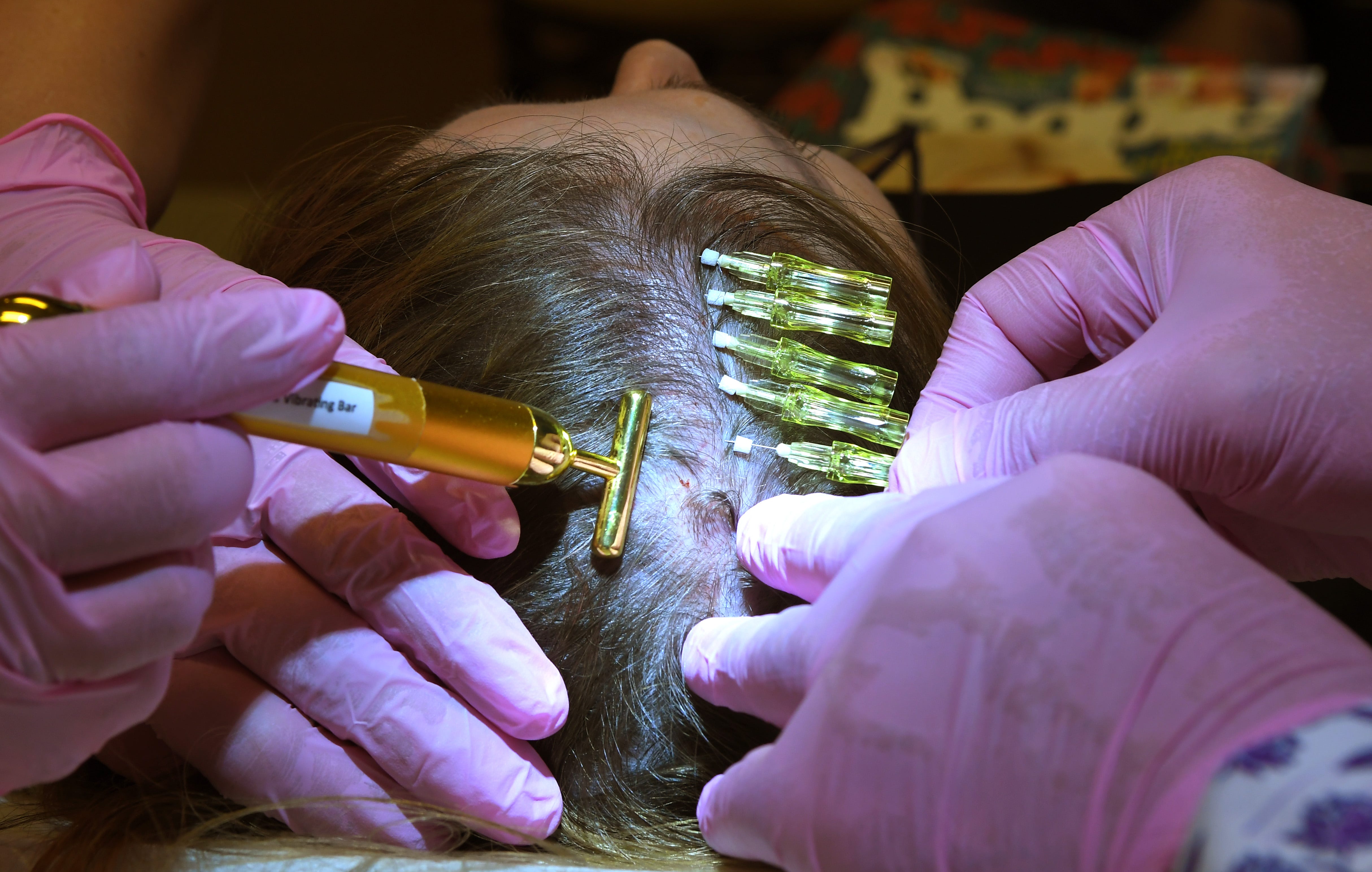 Invigorating procedure makes thinning hair grow thicker