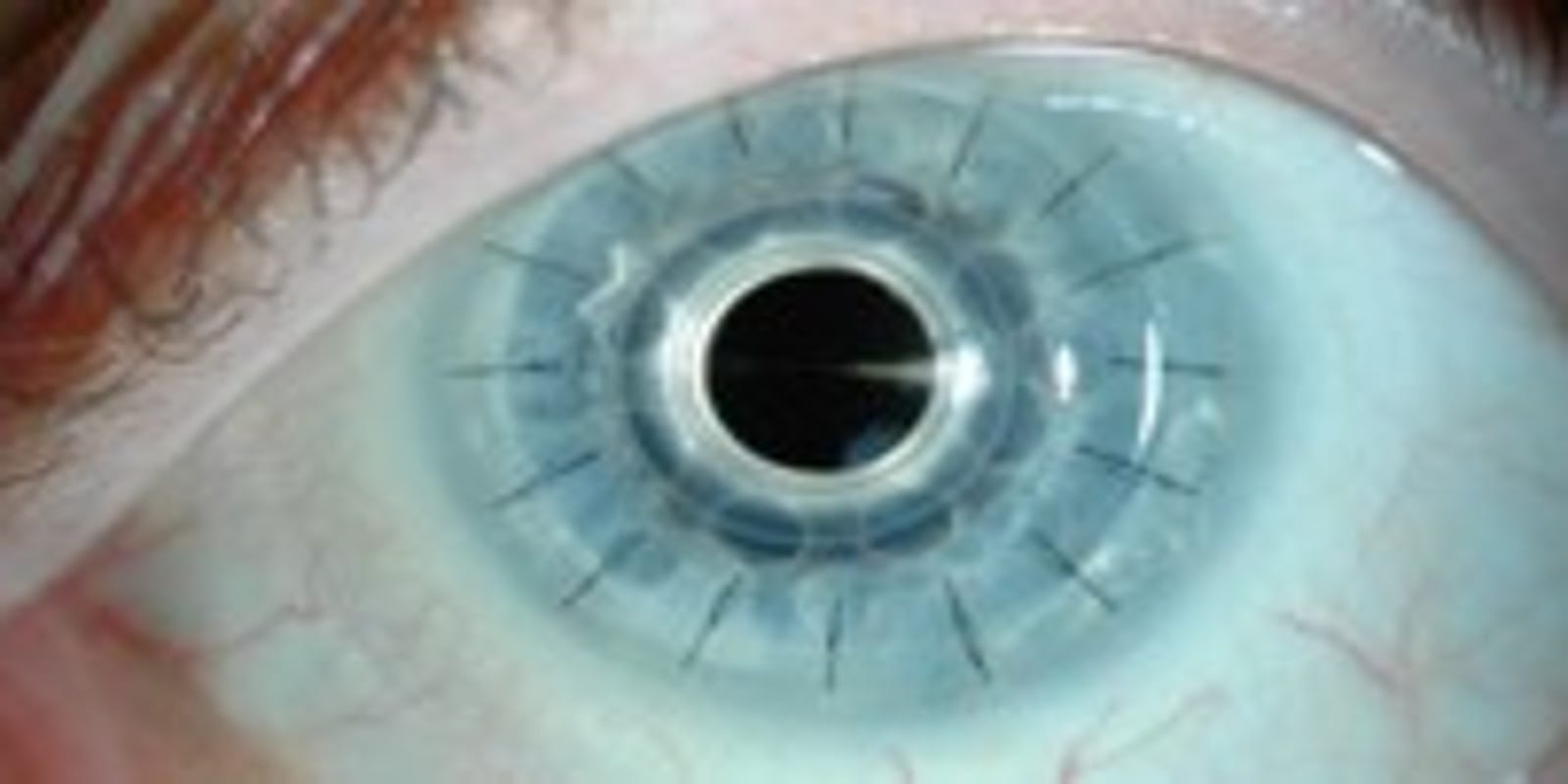 Nashville eye doctor performed world’s first artificial cornea implantation