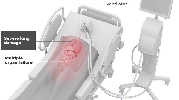 How a mechanical ventilator works.
