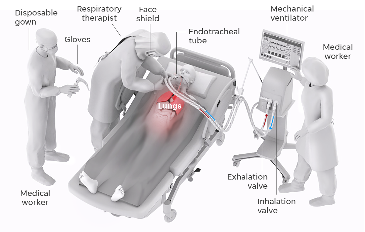 Coronavirus ventilator: How it works, why COVID-19 patients need it