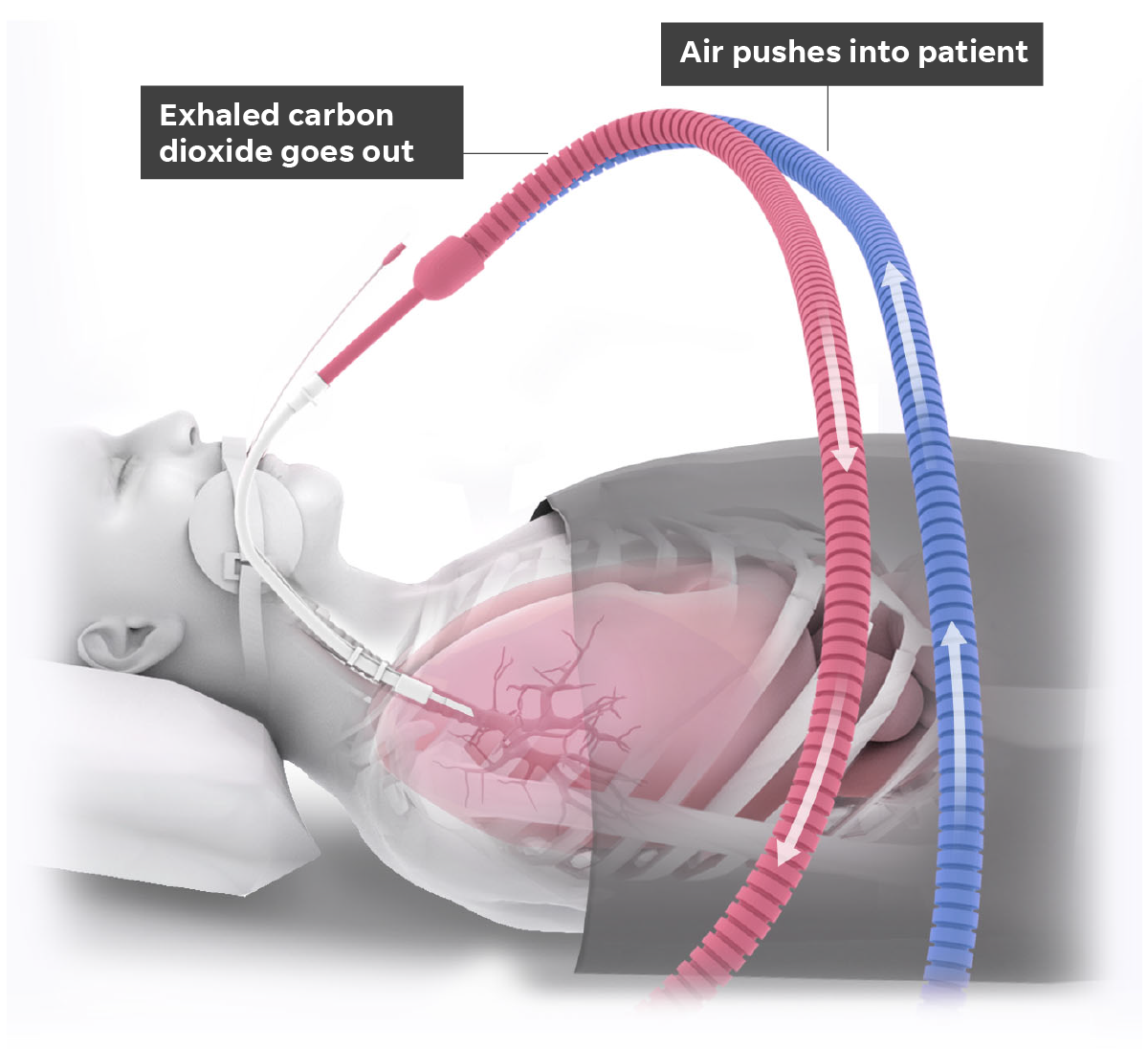 How does mechanical ventilation work during an operation?