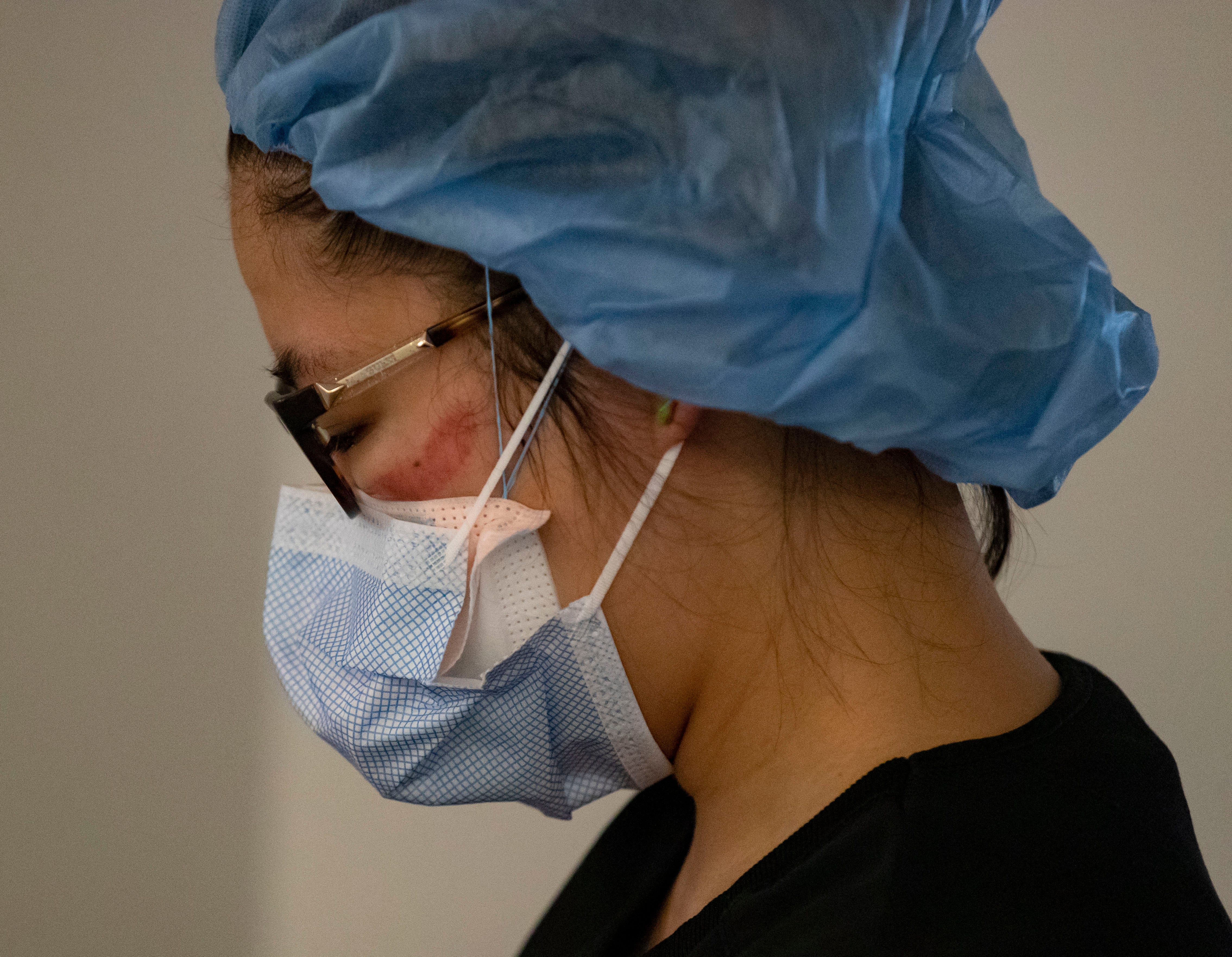 In this Tuesday, April 7, 2020 photo, nurse Amanda Chow has goggle marks on her face after leaving the room of a COVID-19 patient at Rush University Medical Center in Chicago, during the coronavirus pandemic.