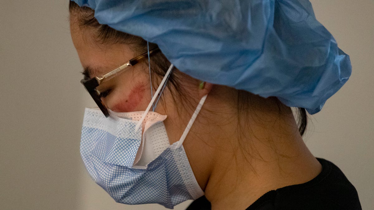In this Tuesday, April 7, 2020 photo, nurse Amanda Chow has goggle marks on her face after leaving the room of a COVID-19 patient at Rush University Medical Center in Chicago, during the coronavirus pandemic in Chicago. (Brian Cassella/Chicago Tribune via AP) ORG XMIT: ILCHT102