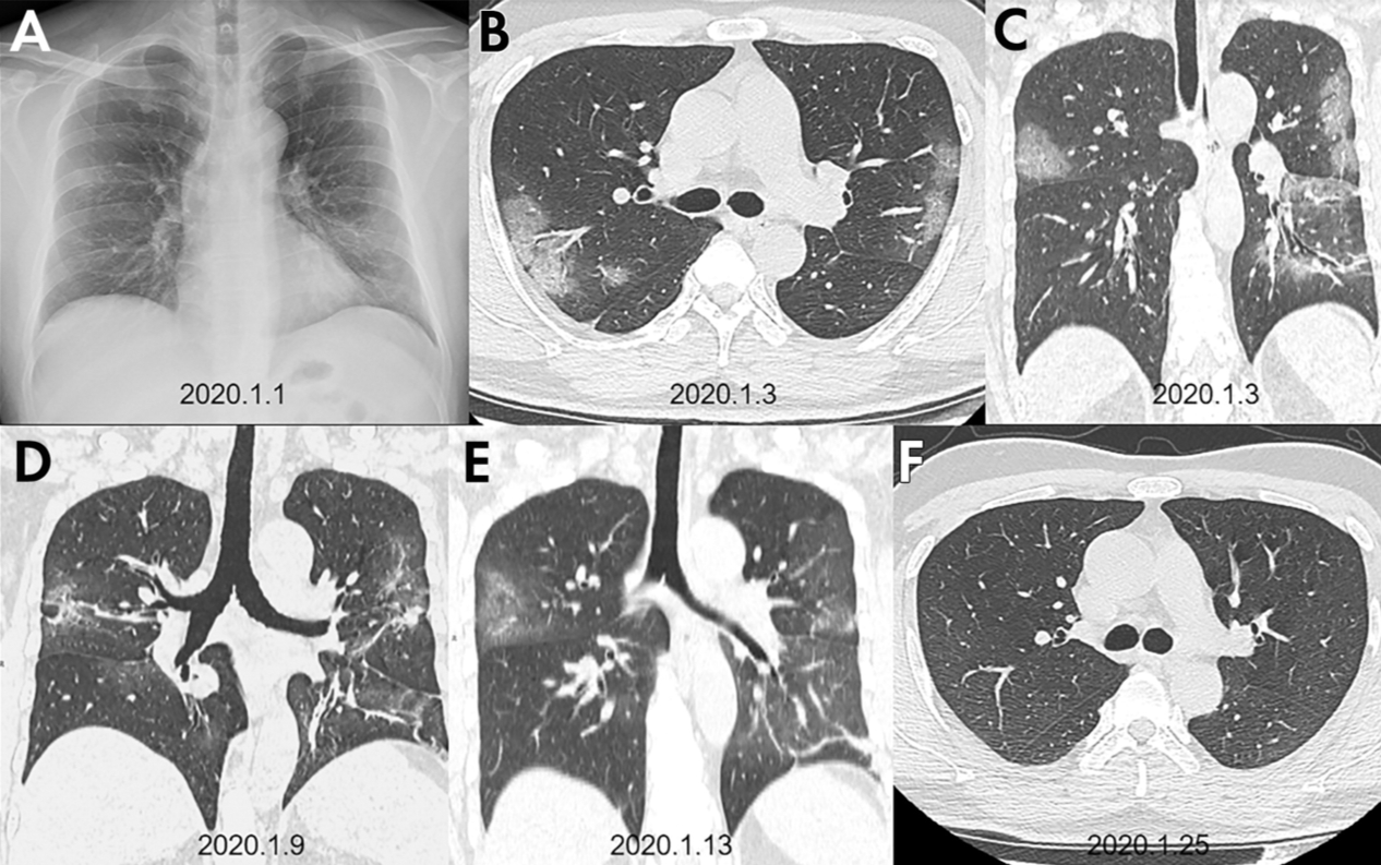 CT scans of patients with COVID-19 reveal patchy white areas of the lung where the lung has been damaged by the virus. These patterns are known as ground-glass opacities and indicate areas of inflammation, fluid buildup and tissue damage.