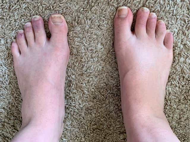Uw Study Of Covid Toes May Help Science Understand The Pandemic