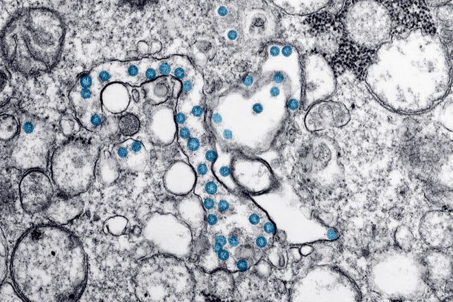 This 2020 electron microscope image made available by the U.S. Centers for Disease Control and Prevention shows the spherical particles of the coronavirus, colorized blue, from the first U.S. case of COVID-19.