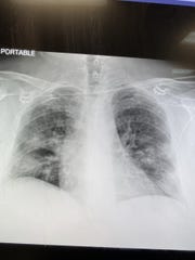Rep. Randy Fine shared a photo of his lungs showing significant damage from COVID-19.