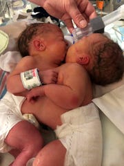 Amelia and Sarabeth Irwin, conjoined twins, at C.S. Mott Children's Hospital in Ann Arbor just three days after they were born on June 11, 2019. The twins underwent successful separation surgery, believed to be the first of its kind in the state, on Aug. 5.