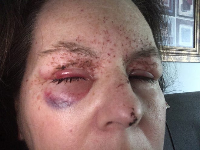 Cindy Eckley shares an image of her face injured by a sandbag thrown from an overpass while she was driving.