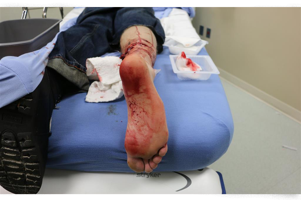 A hospital photo of the ankle injury after Hernando County deputies ordered their K9 to attack.