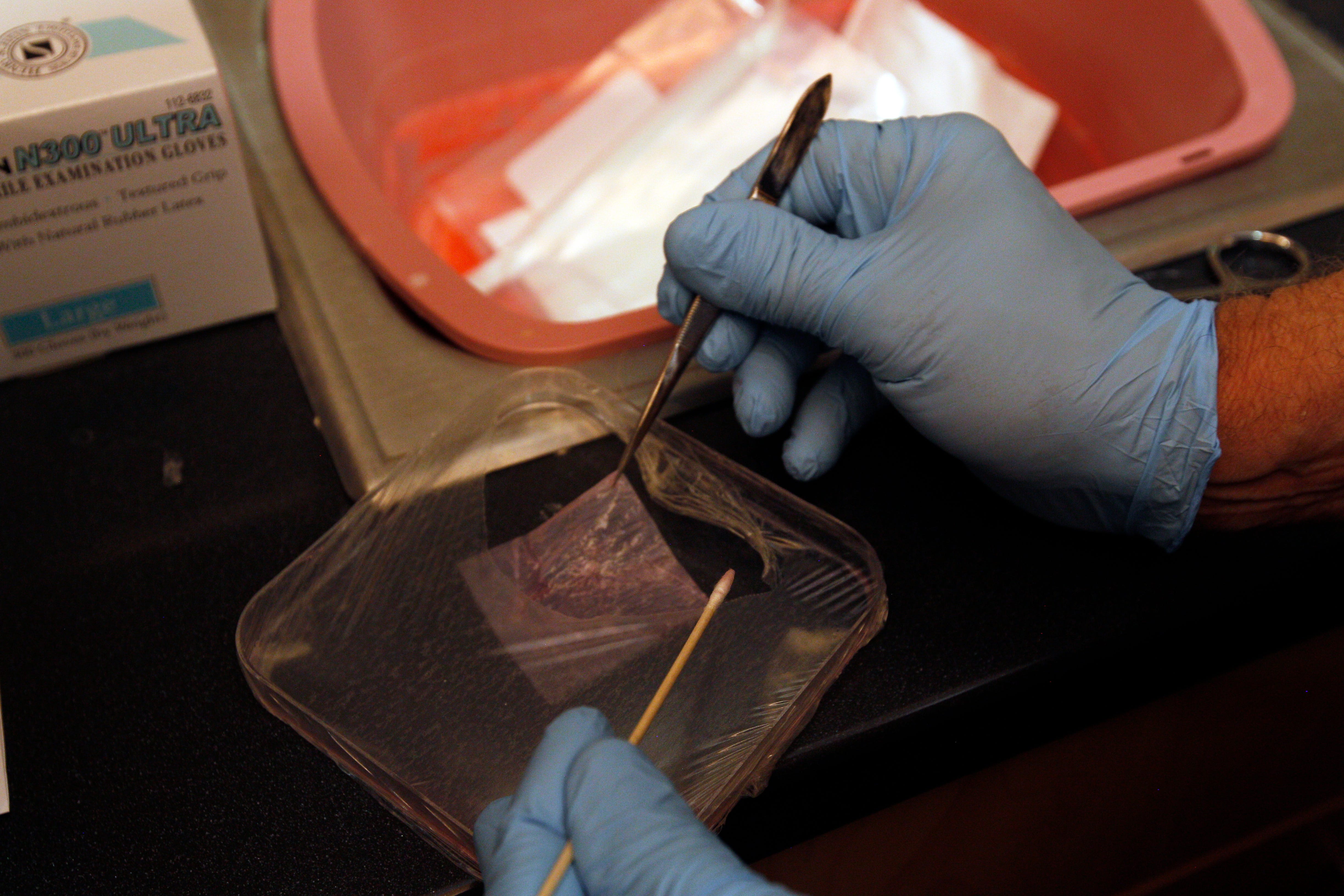 Scottsdale podiatrist Richard Jacoby prepares a skin graft for his patient Janelle James.