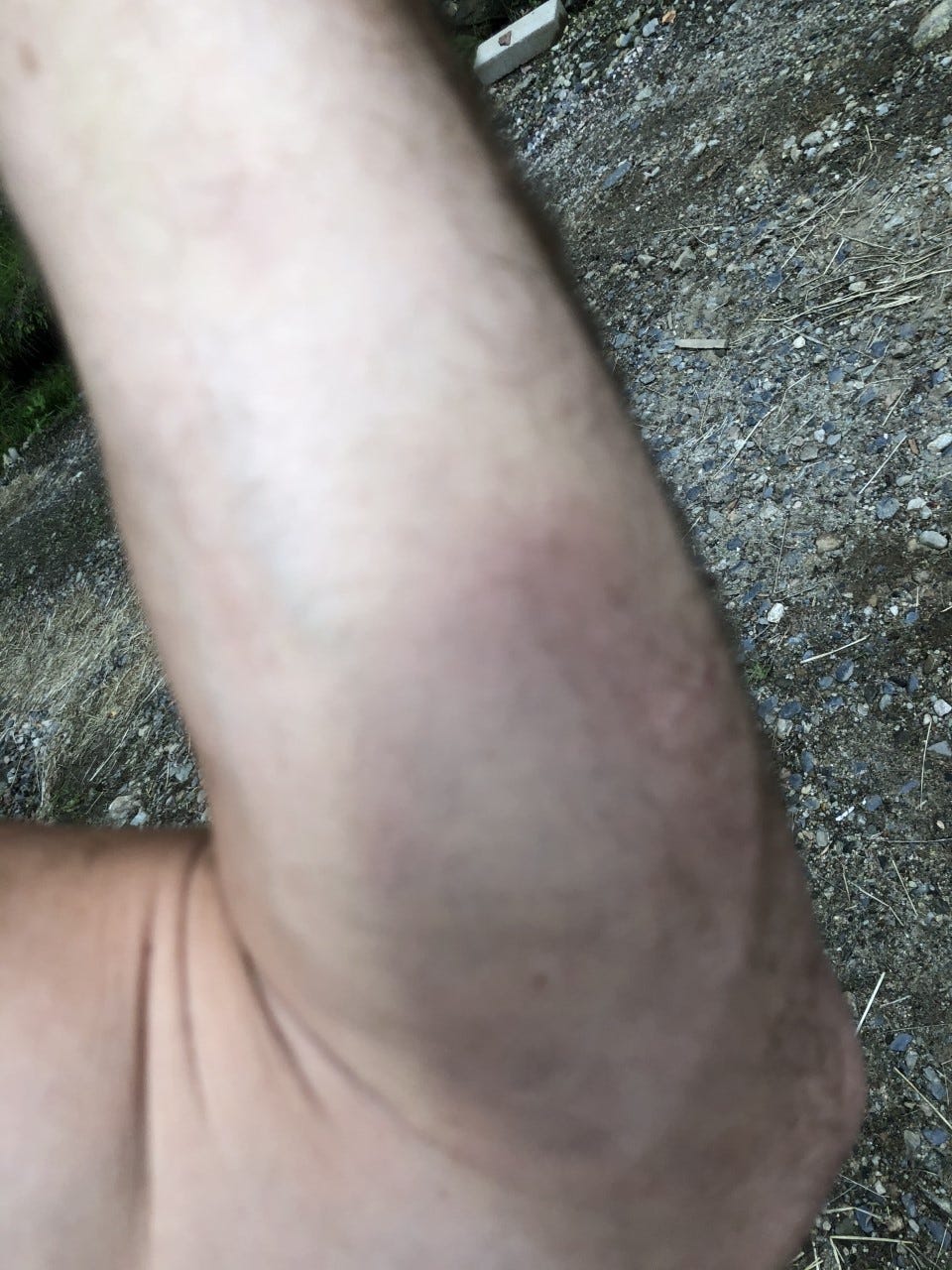 Jesse Telford, an emergency room charge nurse at Beth Israel Deaconess Hospital in Plymouth, Mass., said he and co-workers are verbally or physically assaulted five or six times per shift. He was assaulted in August. Here is one of the injuries he suffered.
