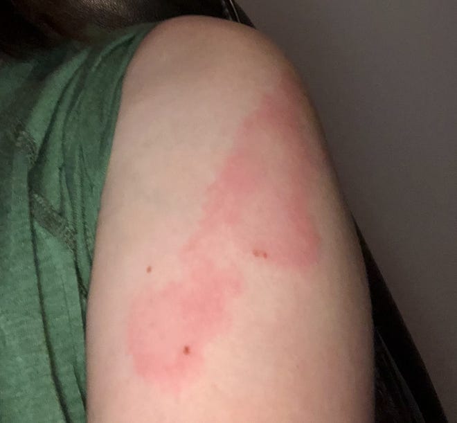 'COVID arm' Moderna vaccine rash a harmless side effect, doctors say