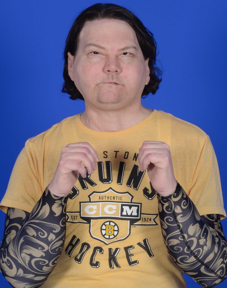 Joseph DiMeo, 22, is adapting well to his new face and hands. Sensation is slowly returning to both, and his hand rehabilitation is way ahead of schedule.