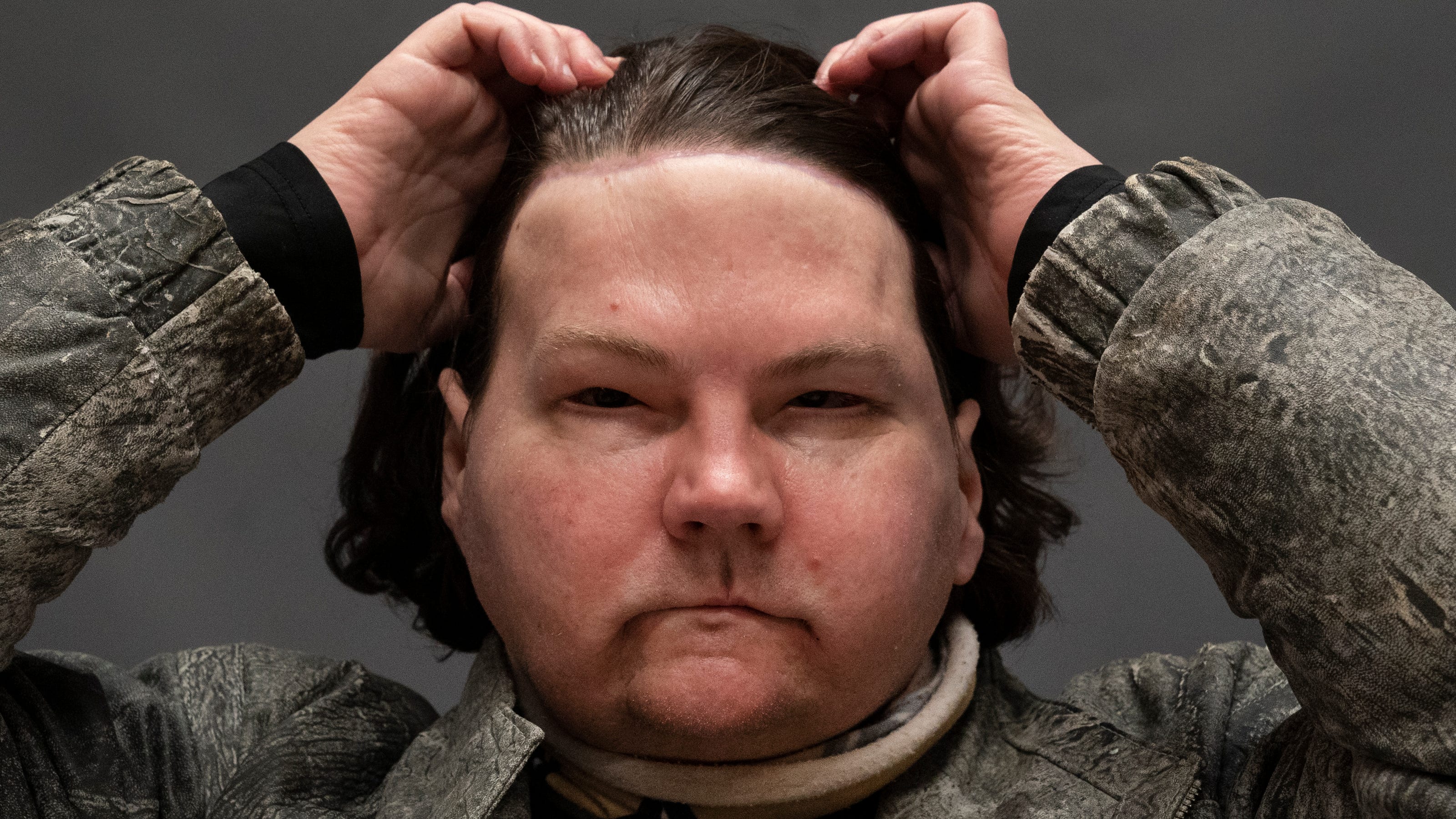 Rare transplant give N.J. burn victim new face and hands; it's working