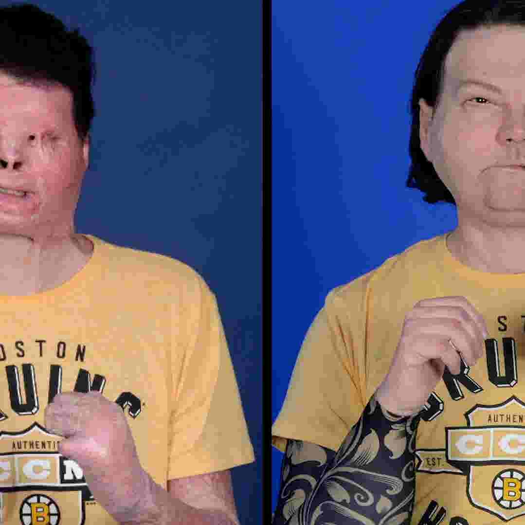 New Jersey Man First To Receive Face And Double Hand Transplant It was the fourth face transplant carried out by rodriguez, and the first hand transplant carried out dimeo read from a short statement where he thanked his medical team, family and the sacrifice and. face and double hand transplant