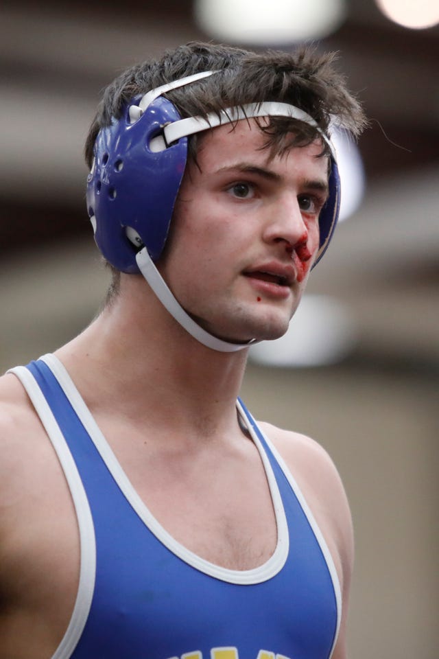 BGA's Jack Revere bleeds during his TSSAA Division-II state wrestling tournament 170-lb championship bout against McCallie's James Whitworth at the Chattanooga Convention Center on Thursday, Feb. 25, 2021, in Chattanooga, Tenn.