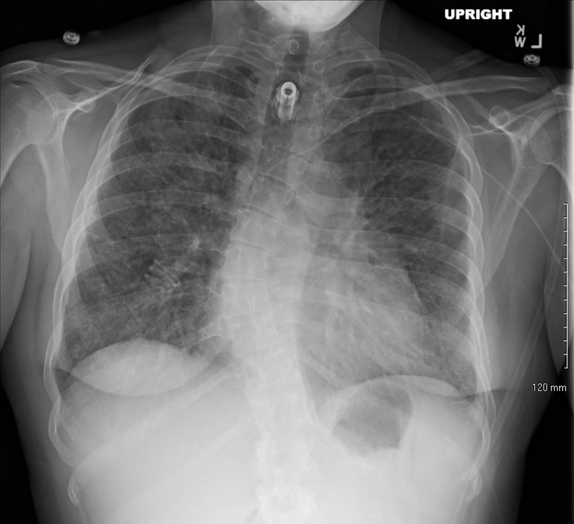 Kelsey L.Townsend, January 25, 2021 chest x-ray 
(most recent chest x-ray showing significant improvement):