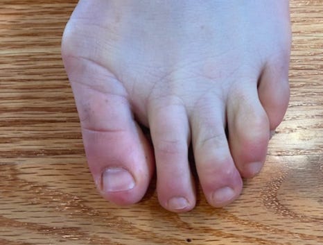 COVID toes, a reaction similar to chilblains that can occur in rare cases after receiving the Pfizer or Moderna COVID-19 vaccines. It is annoying but not life-threatening, say dermatologists.