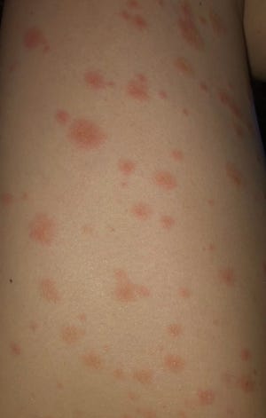 Full body rashes can occur in a small number of patients who have received either the Pfizer or Moderna COVID-19 vaccines. It is not life-threatening and fades over time.