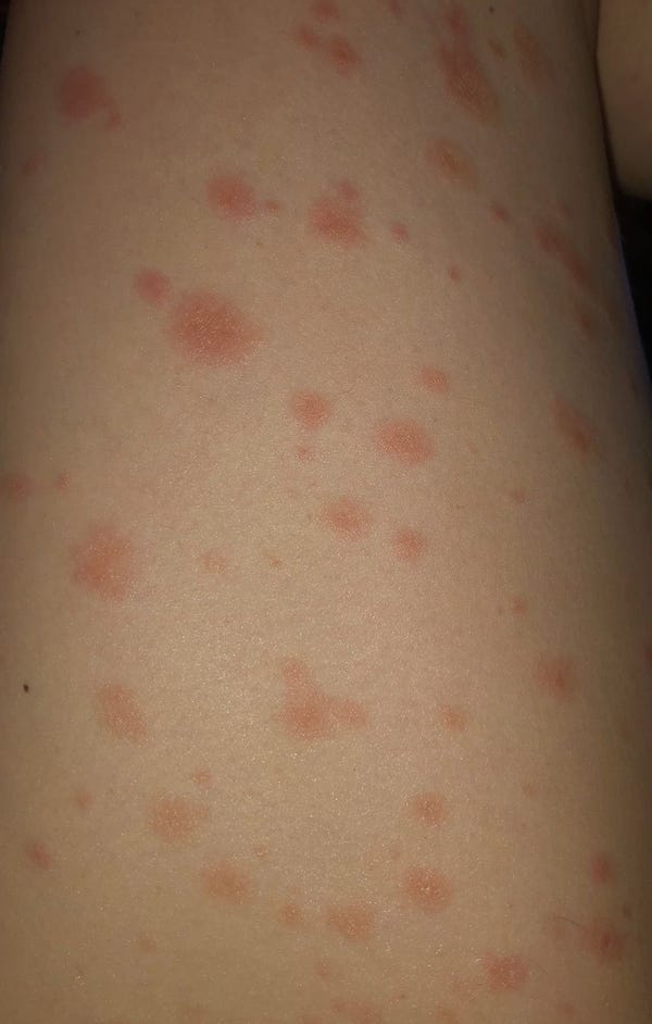COVID vaccine side effects study: Rashes, skin reactions not dangerous