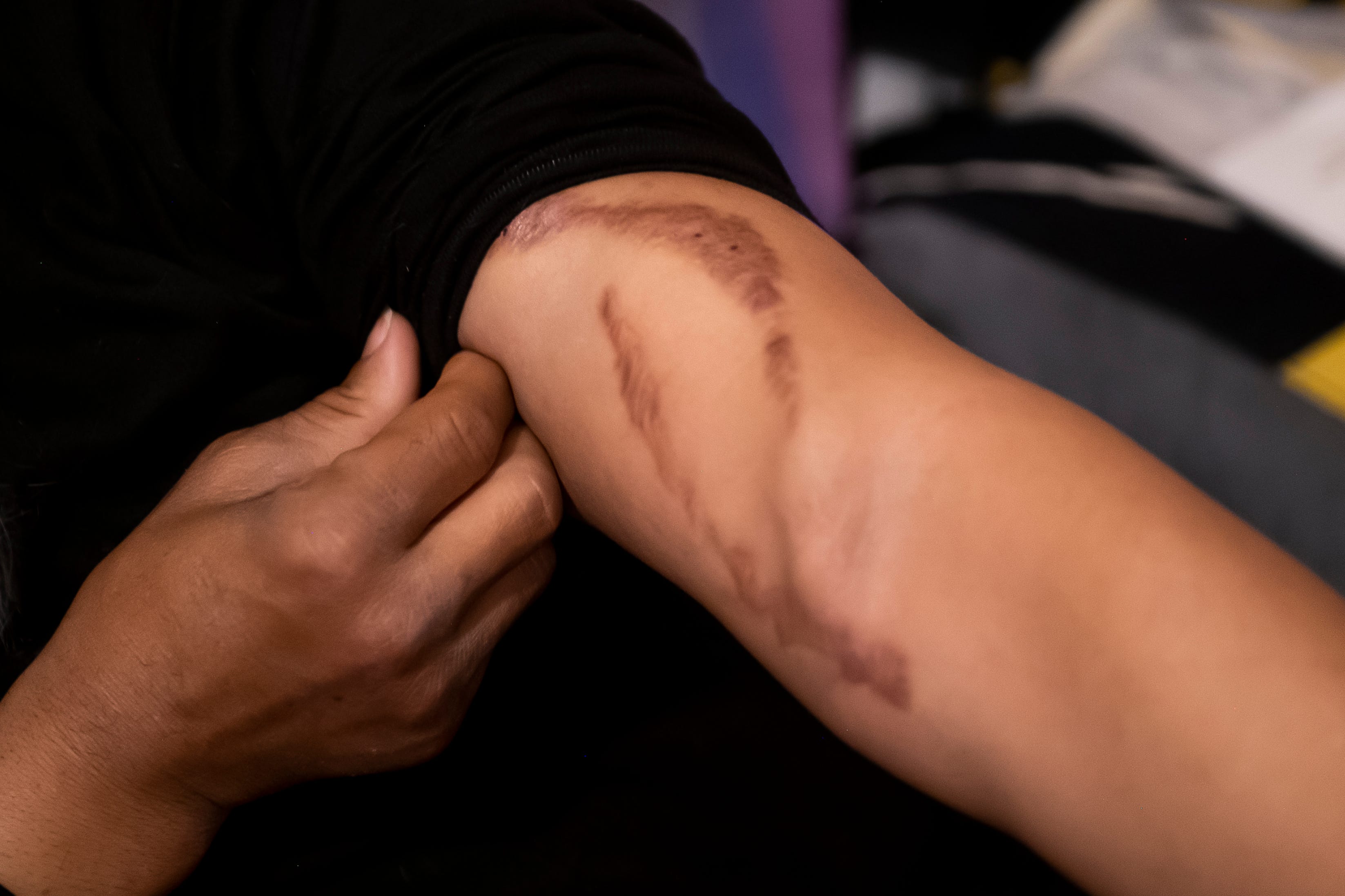 Rodney Gregory, 54, lifts up his sleeve to reveal the scars that have developed on his left arm from four years of dialysis. Gregory, who is still on the wait list to receive a new kidney, goes to dialysis three times a week, for four hours each session.