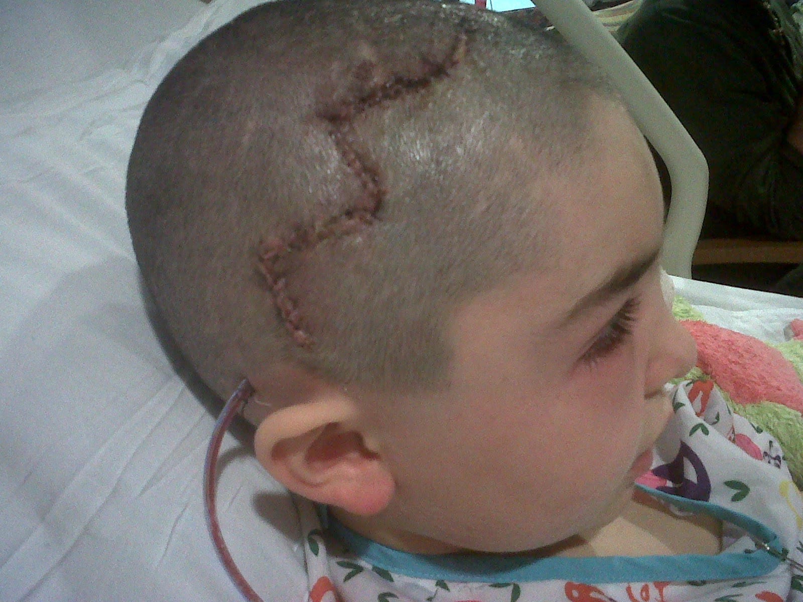 Doctors performed life-saving surgery to remove an AVM in Antonio Dinello's brain in 2011. (Courtesy of the Dinello family)