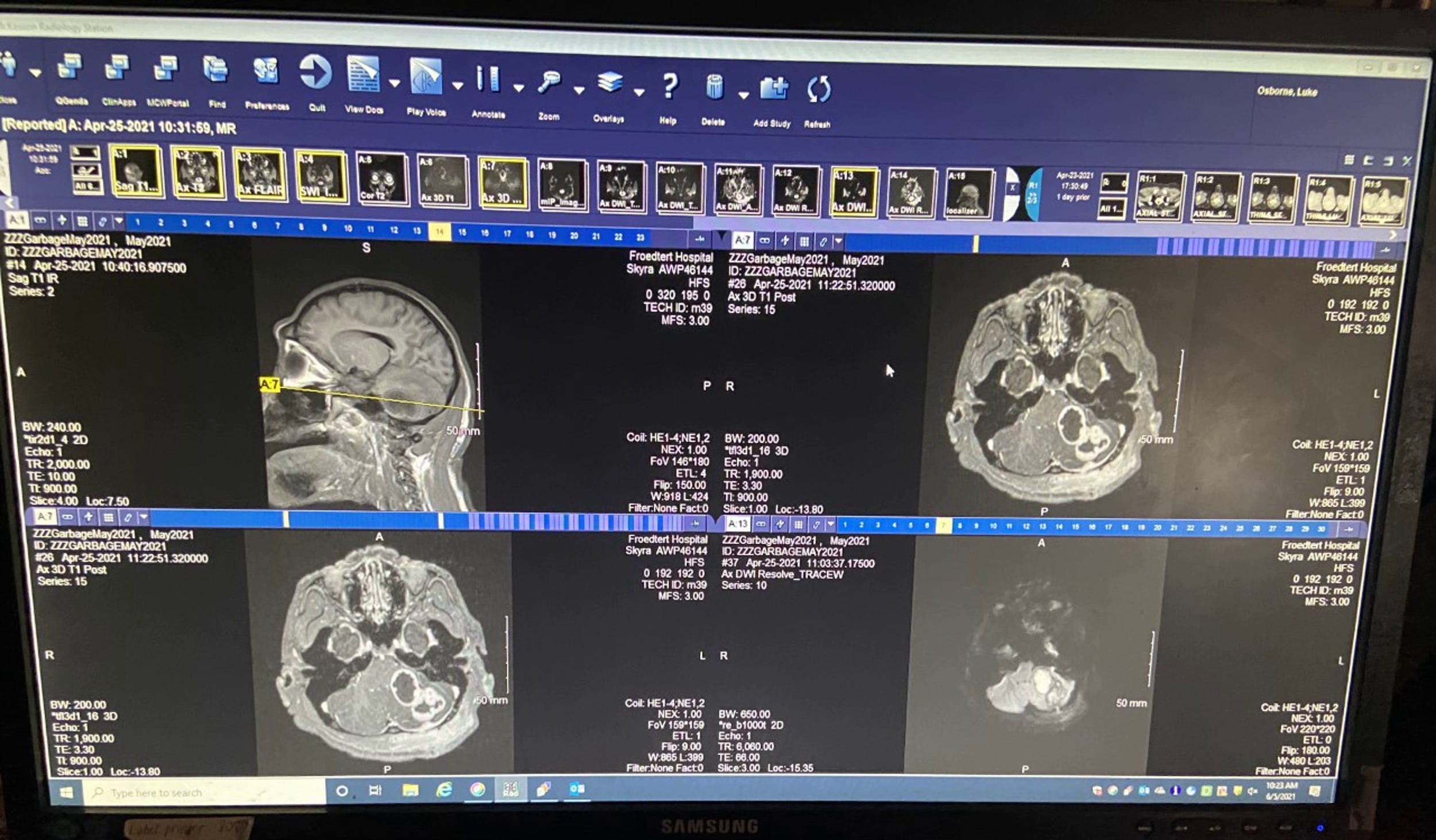 Scans of Qasai's brain reveal he is suffering from two brain abscesses.