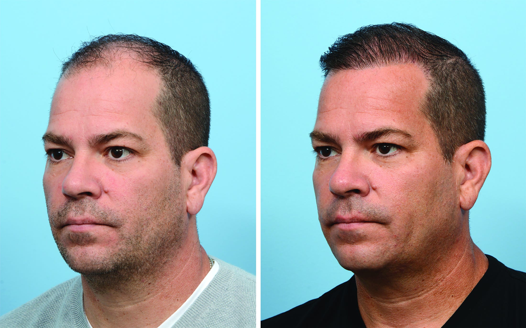 This innovative procedure can restore hair and combat hair loss This innovative procedure can restore hair and combat hair loss