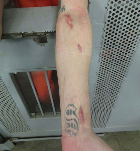 Dustin Brislan shows the scars on his arms from self-harming behavior which he says is a result of a lack of adequate mental health care in Arizona prisons.