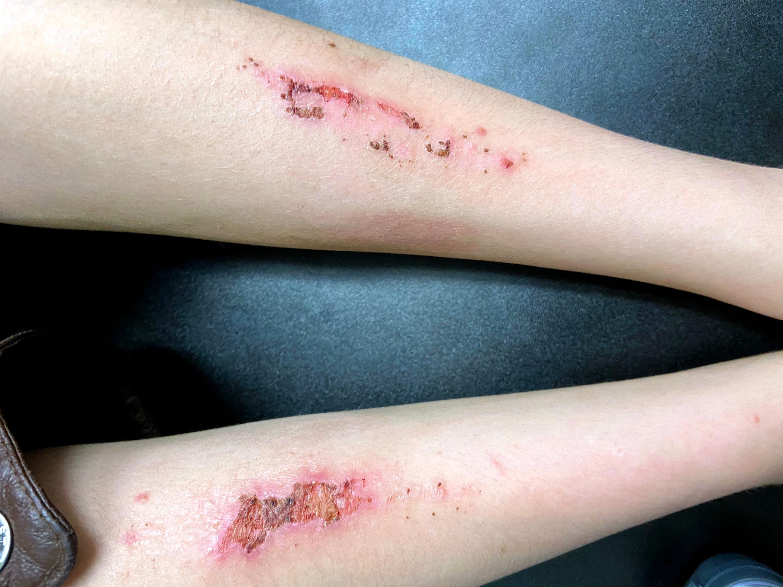 Kids put into isolating circumstances in locked institutions with psychiatric conditions can continue to harm themselves. In this photo taken by an adult visitor, a child's arm wounds have become infected at a psychiatric center North Carolina sends kids into. The facility has battled issues with staph infections due to building cleanliness problems.