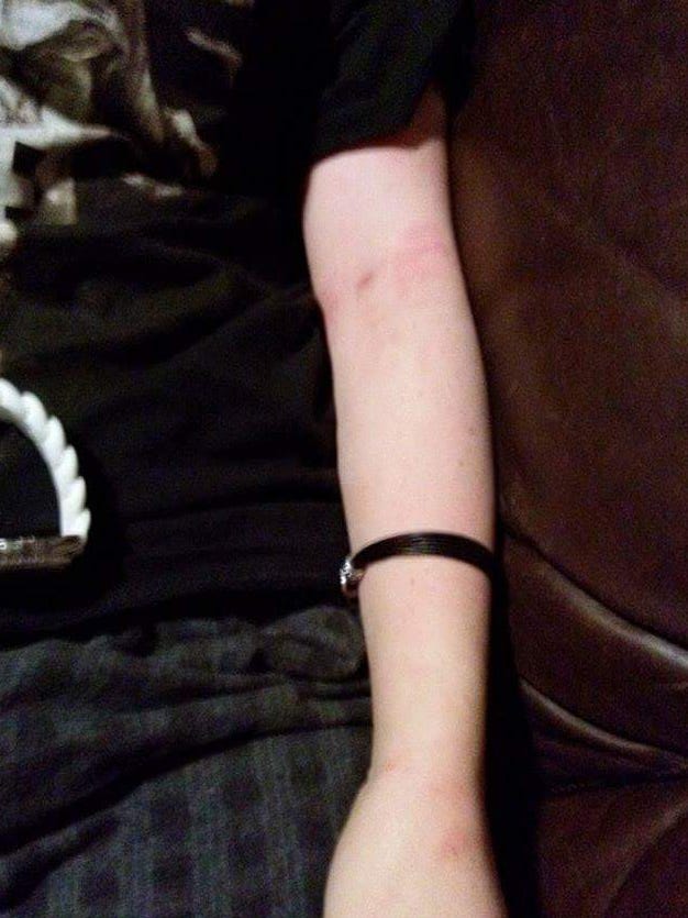 A police officer used a Taser on Tiara Helm while four others pinned her down after she had a seizure at a concert. The photo shows marks on her arm from the encounter.