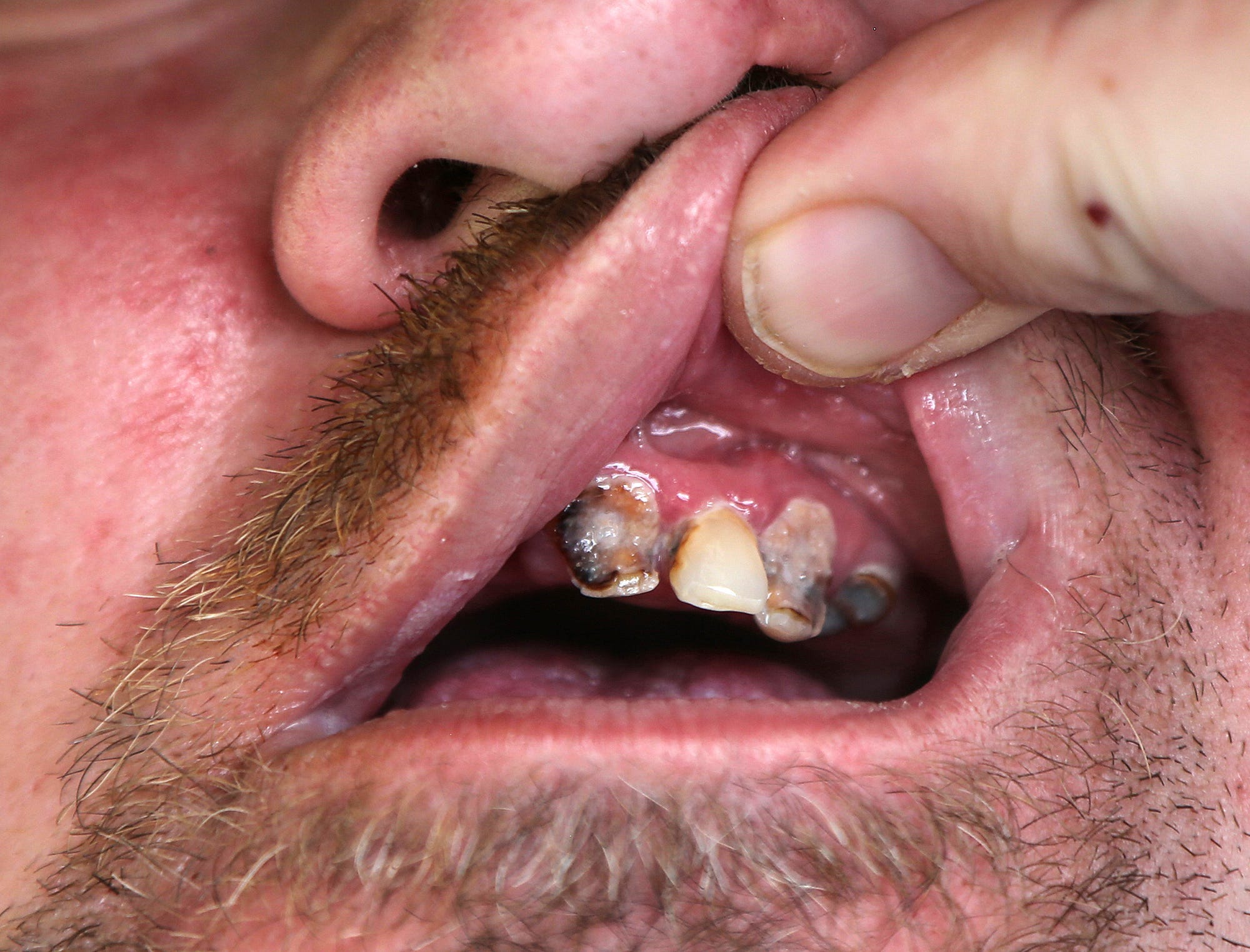 Curtis Cole shows off a few teeth in need of dental care. He has faced numerous barriers to getting the issues resolved, living in constant pain.