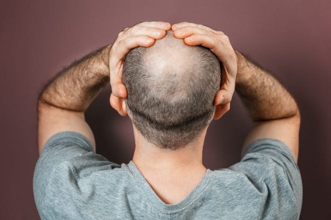More than half of all men over the age of 50 have some degree of male pattern baldness.