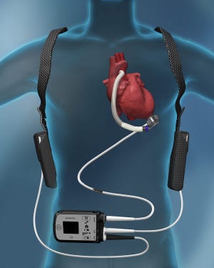 The DAVG Heartmate III pump.