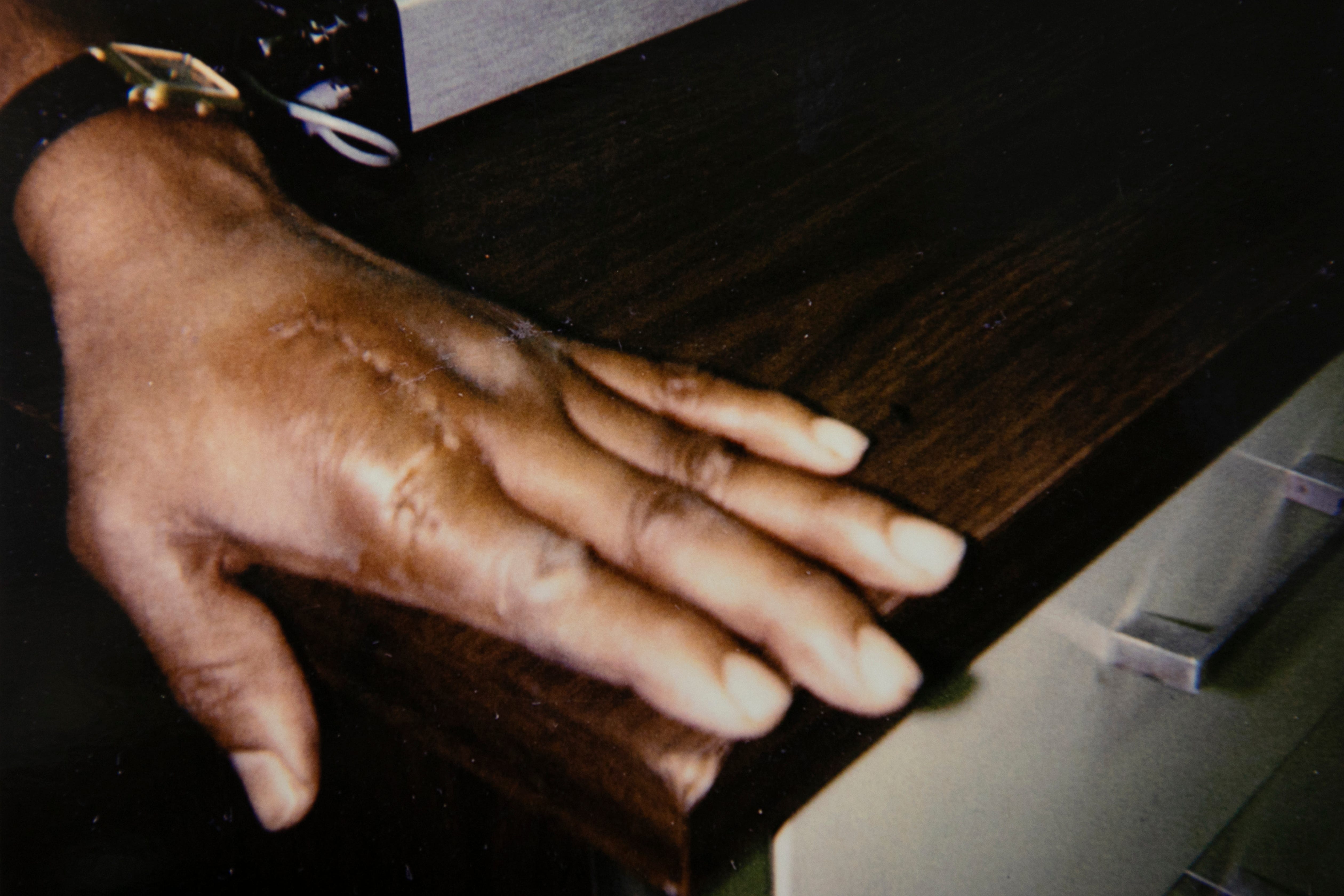 A photograph from police evidence files showing a wound on Elwood Jones's hand.