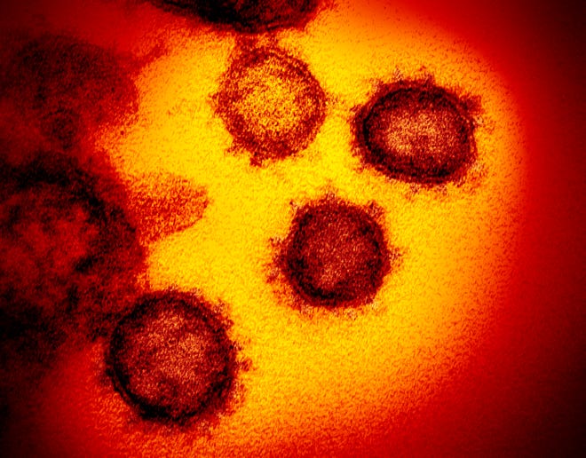This undated electron microscope image made available by the U.S. National Institutes of Health in February 2020 shows the Novel Coronavirus SARS-CoV-2. Also known as 2019-nCoV, the virus causes COVID-19. The sample was isolated from a patient in the U.S. (NIAID-RML via AP) ORG XMIT: ny402