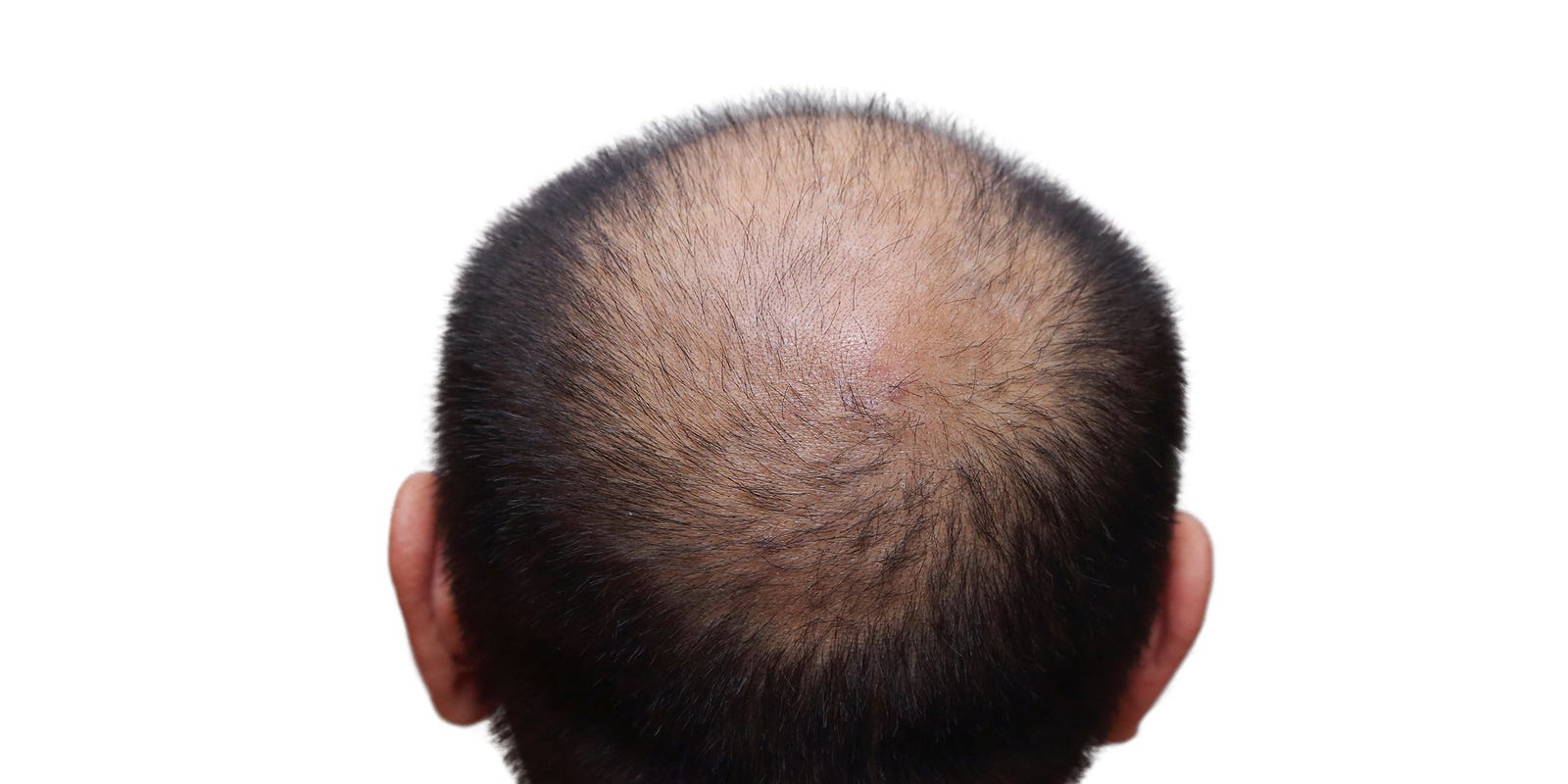 Boomer Health: New study details most effective options for male pattern baldness