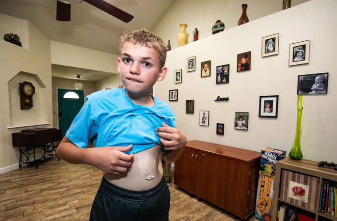 Issac shows his "button," which is a feeding tube, attached to his belly button, on Feb. 25, in Ocala. Issac,14, is autistic, also suffers from auto immune encephalitis. Isaac receives an antibodies injection once a month called IVIG. He also receives a drug called Rituximab every six months to combat the auto immune encephalitis, which resets his immune system.
