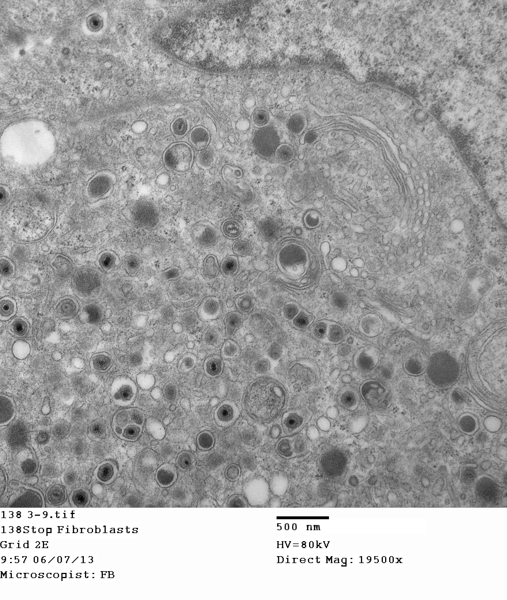 This image, taken using an electron micrograph, shows a CMV infection inside a cell. The circles with black dots in the middle are the virus particles.