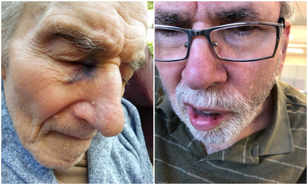 Jim Mundschau, left, suffered a black eye last year at the Union Grove veterans home. His wife said she was told it happened when aides were putting on his sunglasses. Randy Krall, right, suffered an unexplained cut lip and chipped tooth in July 2019, according to his wife. A day later, a large bump was found at the top of his head.